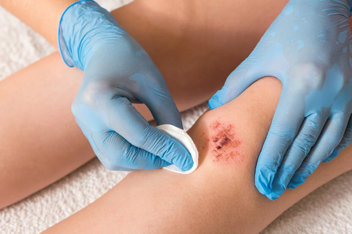 Disinfecting a wound with alcohol