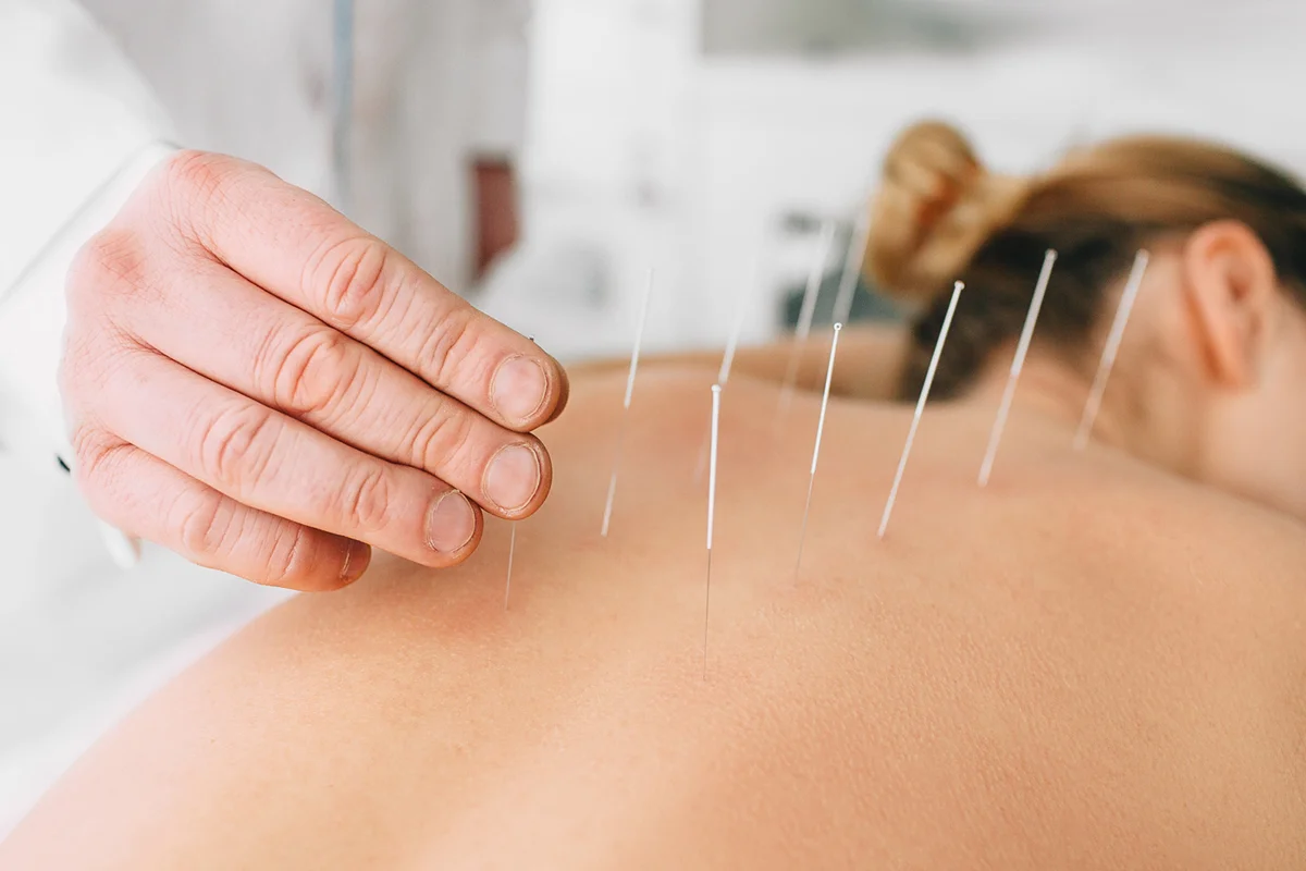 Woman having acupuncture treatment on her back