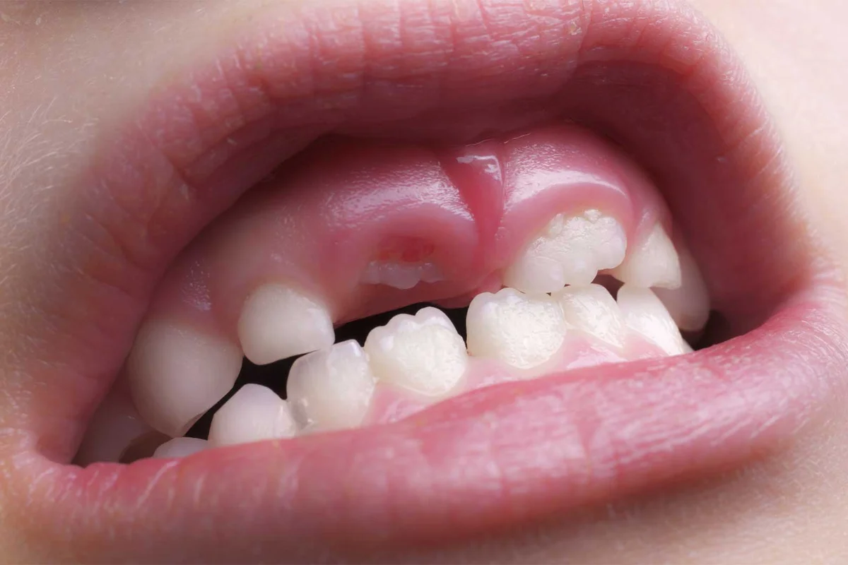 erupting tooth