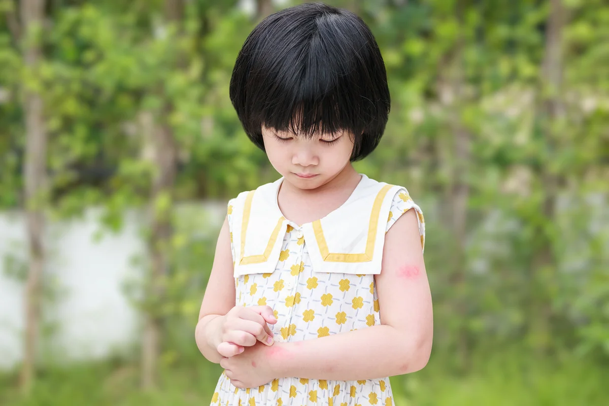 Little girl has skin rash allergy itching and scratching on her arm