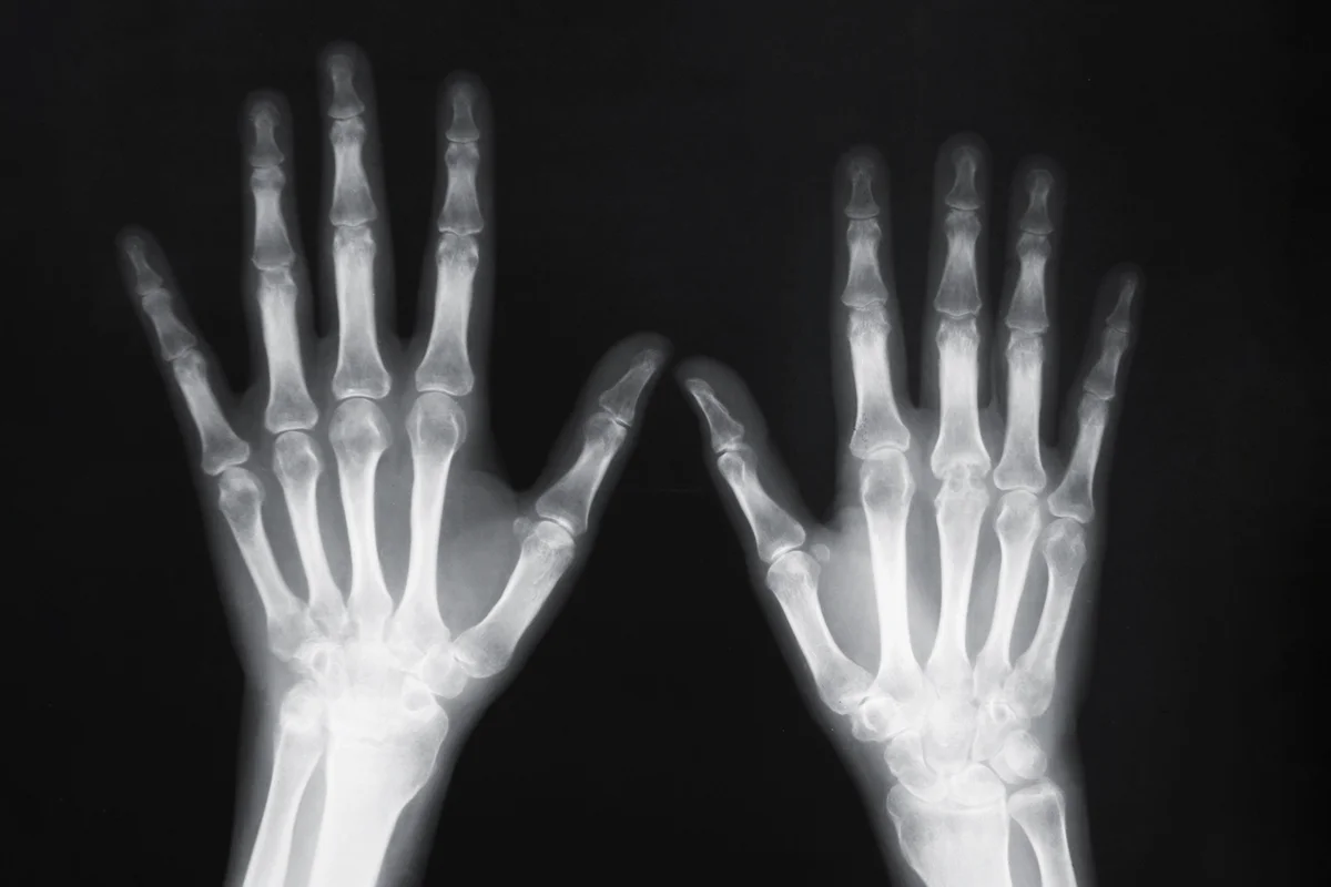 X-ray of human wrist with arthritis