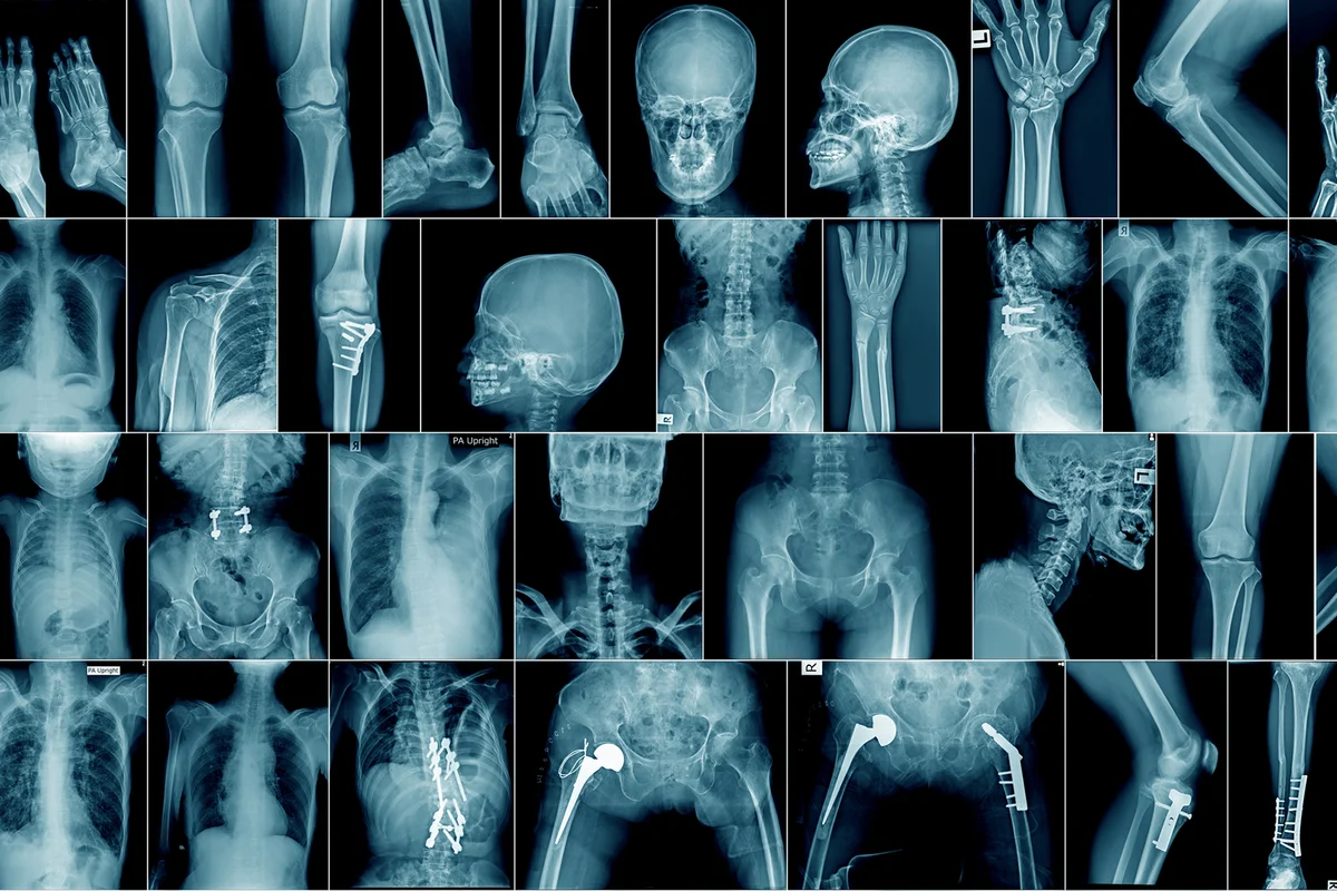 Collection x-ray multiple area