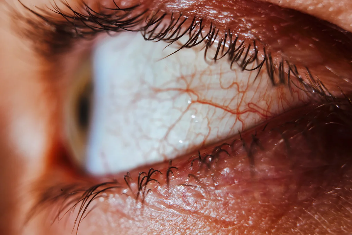 Tired man's eye with visible red veins
