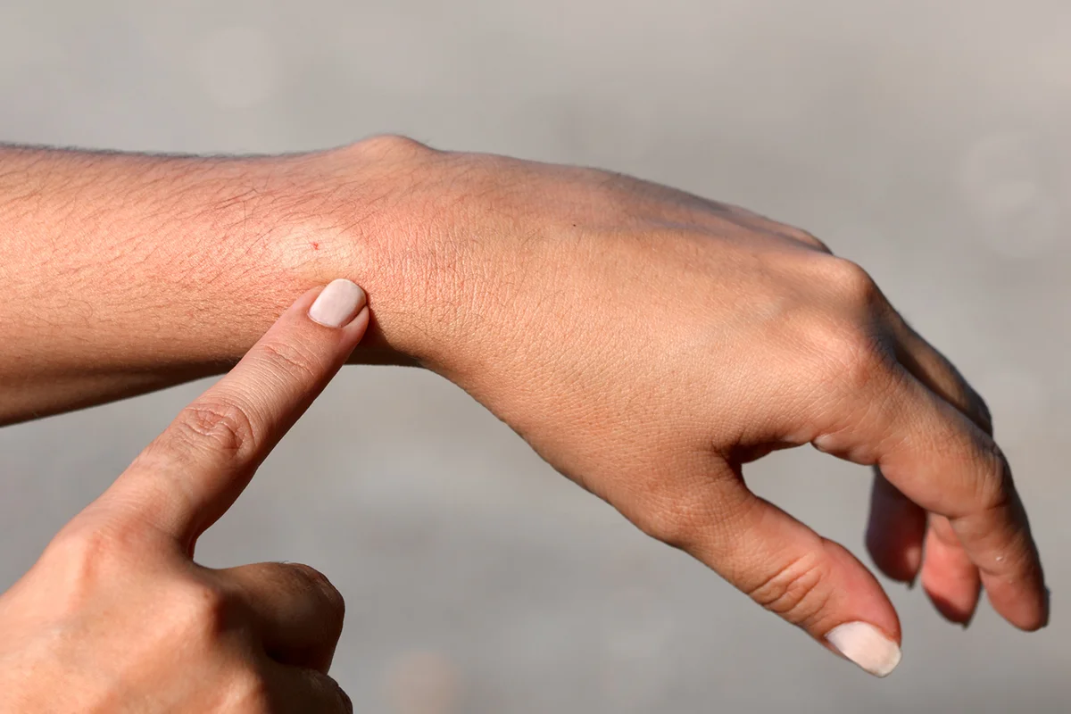 Hand pointing to a person's wrist where they have a bee sting