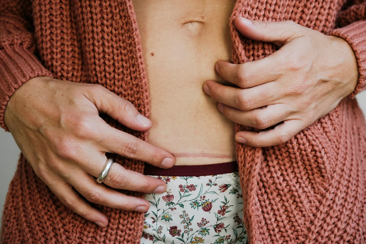 woman with c-section