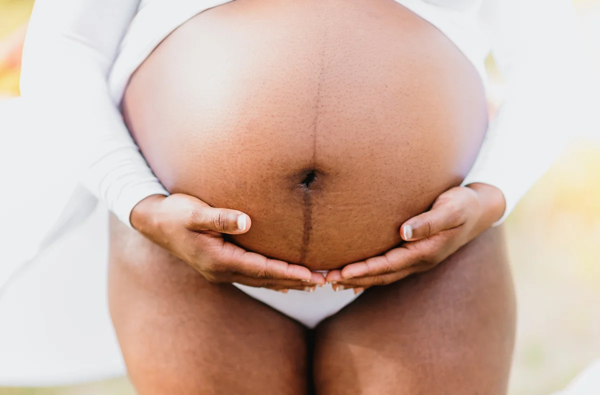 Pregnant woman with some skin discoloration