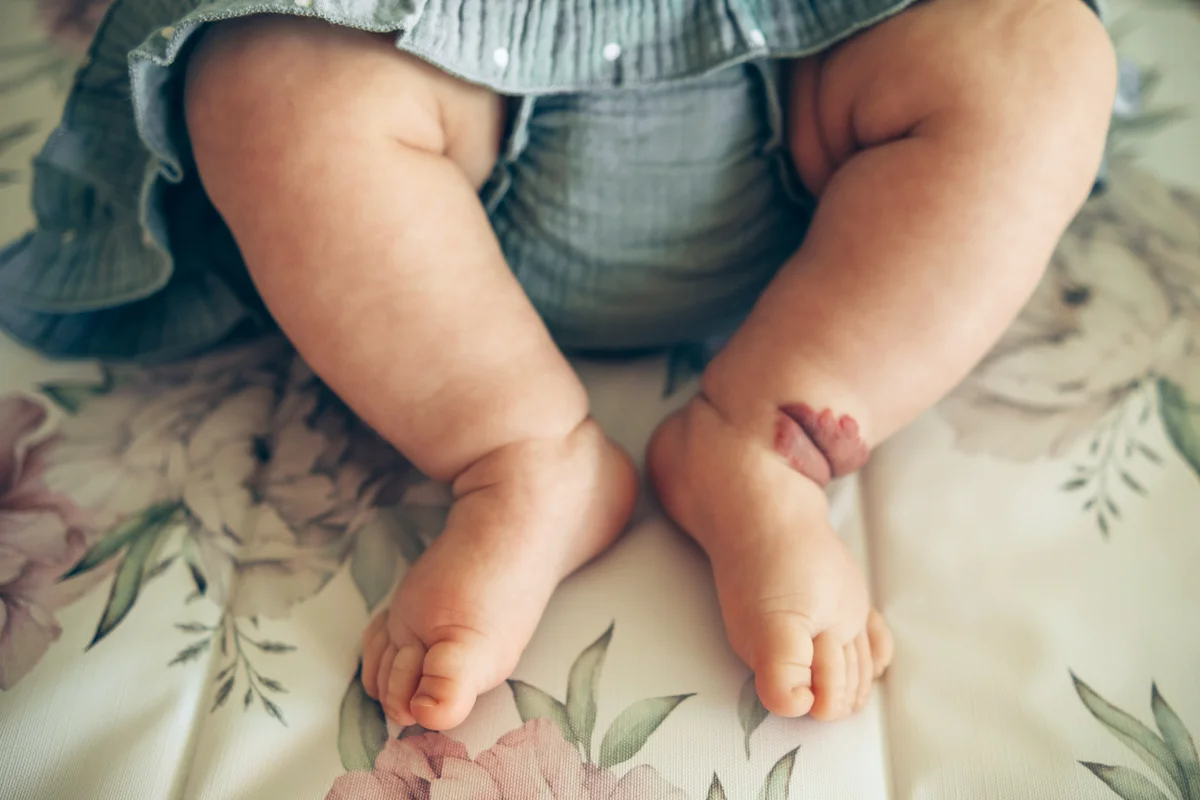 Baby feet with birthmark