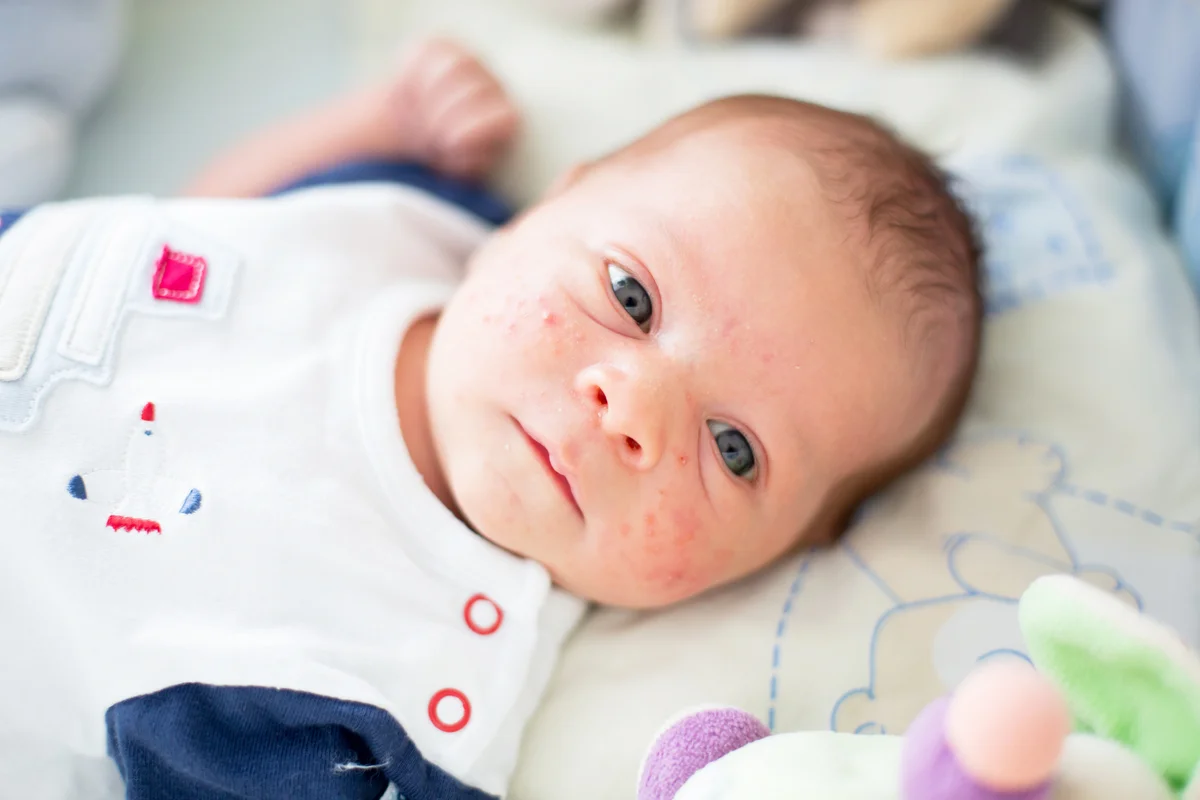 Newborn baby with acne rash on his face