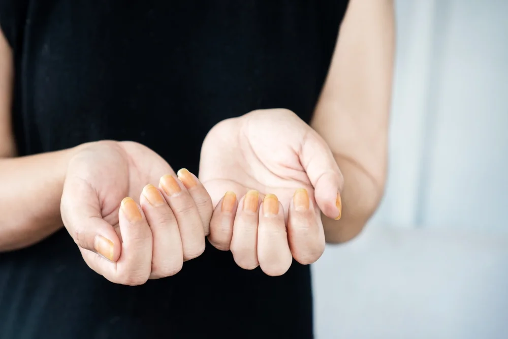 Close-up of woman's hands showing yellow-stained nails