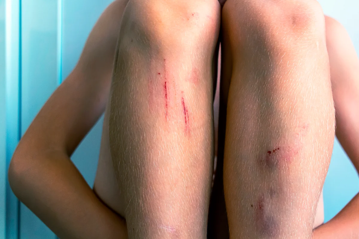 Leg of child with bruise (injury). Pain, hematoma, first aid. Healthcare, children's ambulance concept. Selective focus