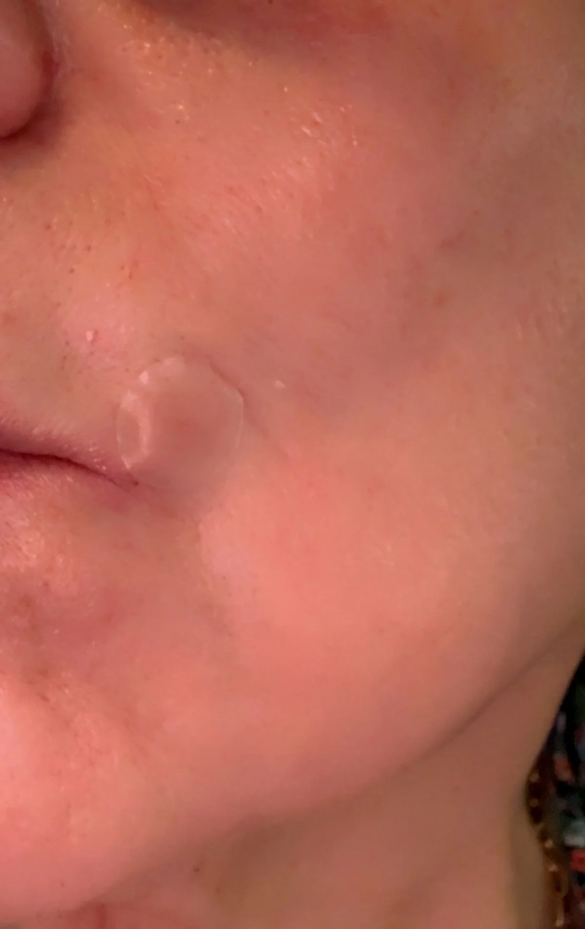 Pimple patch from Grace & Stella