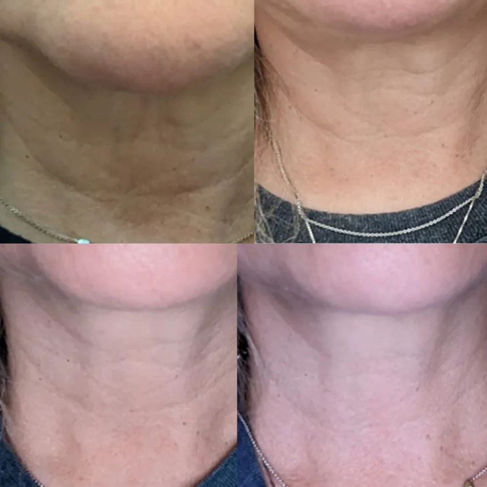 before/after neck cream