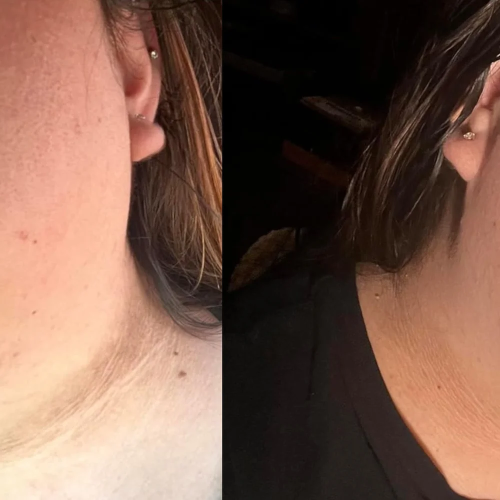 kojic acid soap before and after on dark skin around neck