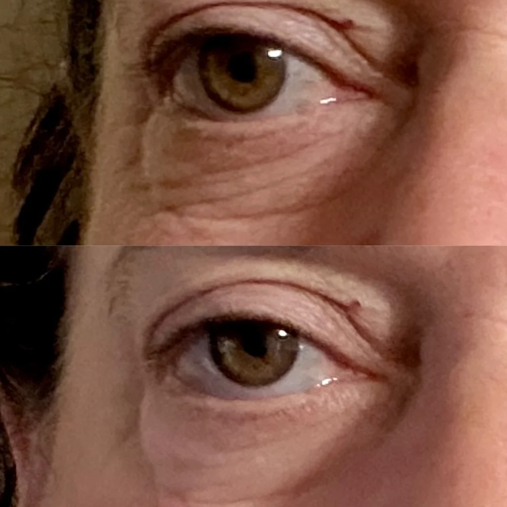 Maree eye patches before & after