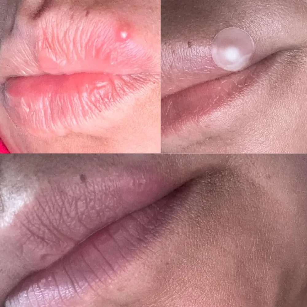 Pimple patches before during after
