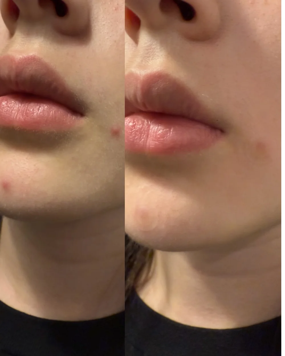 Rael pimple patches before & after
