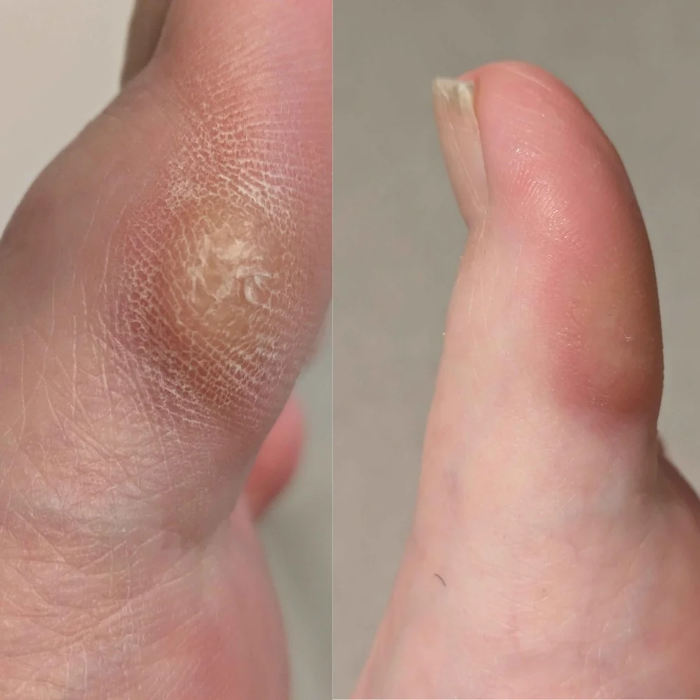 Nuvadermis toe before and after
